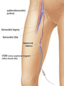 laserové odstranění křečových žil - postup